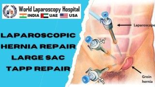 Reinforcing Abdominal Strength: Minimally Invasive Laparoscopic Repair for Recurrent Hernia