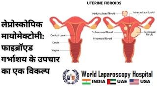 Laparoscopic Cervical Cerclage