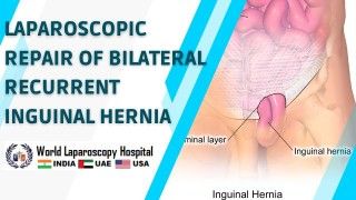 Advanced Precision: Laparoscopic Hernia Repair with Large Sac TAPP Technique