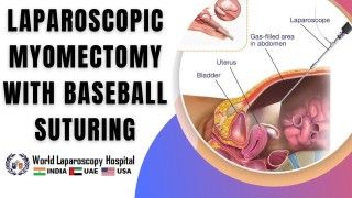 Robotic Roux-en-Y Hepaticojejunostomy in a Post-cholecystectomy Bile Duct Injury