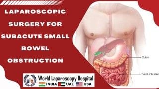 Laparoscopic Management of Perforated Appendicitis