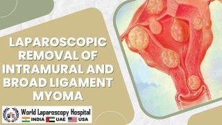 Laparoscopic Management of Chronic Ectopic and Myomectomy in same patient