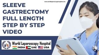Comprehensive Step-by-Step Video: Sleeve Gastrectomy Surgery Guide