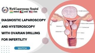 Laparoscopic Myomectomy for Large Deep Intramural Myoma