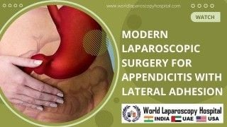 Advanced Laparoscopic Approach for Acute Appendicitis with Lateral Adhesion
