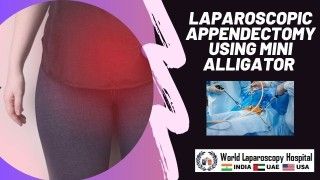 Precision Surgery: Laparoscopic Appendectomy Using Mini Alligator Instruments