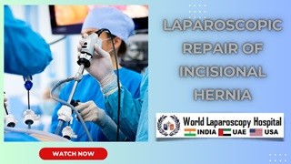 Dr R K Mishra Explaining Laparoscopic Appendicectomy