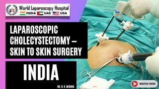 Hysterectomy for Multiple Fibroid by Laparoscopic 3 ports