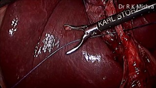 Laparoscopic Roeder's knot demonstration by Dr R K Mishra