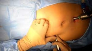 Laparoscopy for Minor Distal Tubal Fimbrial Block