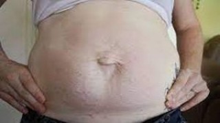 Adhesiolysis and Adhesion Prevension