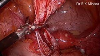 Ovarian Cystectomy by Laparoscopy for Dermoid Cyst
