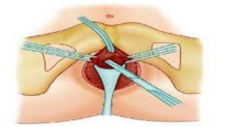 Laparoscopic Repair of Common bile duct (CBD) injury