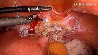 Laparoscopic Radial Hysterectomy Lecture by Dr R K Mishra