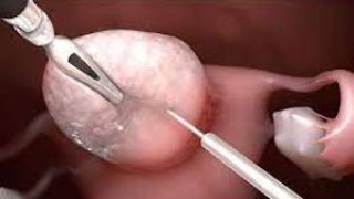 TLH + Sacrocolpopexy Skin to Skin Surgical Video