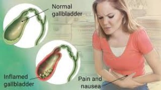 Laparoscopic Cholecystectomy Fully Explained Skin-to-Skin Video with Near Infrared Cholangiography