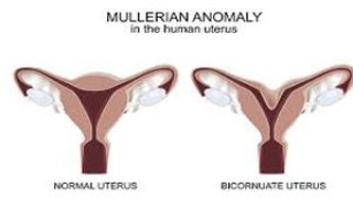 Laparoscopic Removal of Huge Ovarian Cyst