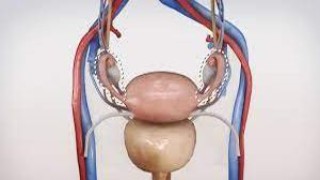 Bilateral Salpingooophorectomy