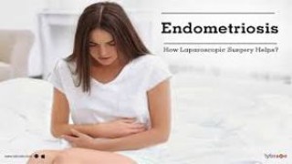 Laparoscopic Surgery for Left Ovarian Dermoid Cyst