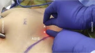 Mishra's Knot - Ideal for Laparoscopic Cholecystectomy