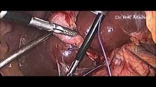High Definition Video of Lap Chole with Extracorporeal Knot to Cystic Duct