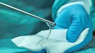 Use of Interceed for adhesion prevention in laparoscopic surgery at World Laparoscopy Hospital