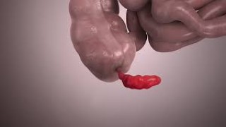 Laparoscopic Fulgration for Mild Endometriosis
