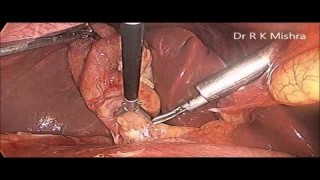 Laparoscopic Removal of Huge Ovarian Cyst