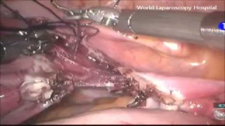 Minimally Invasive Marvel: Laparoscopic Surgery for Ovarian Dermoid Cyst