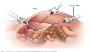 India's First Robotic Ovarian Cystectomy