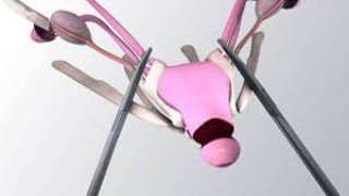 Stopping the Sweat: Thoracic Sympathectomy for Palmar Hyperhidrosis