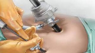 Laparoscopic Appendicectomy by Mishra's Knot