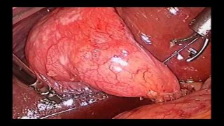 Laparoscopic Management of Chronic Etopic Pregnancy