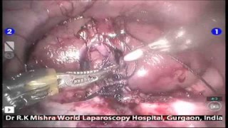 Intraperitoneal Onlay Mesh Repair of Inguinal Hernia