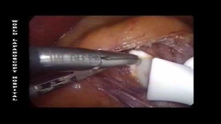 Laparoscopic Gastric Banding