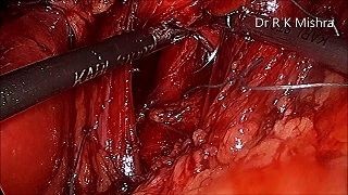 Laparoscopic Nissen fundoplication - Watch Dr. R.K. Mishra's video