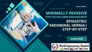 Precision Redefined: eTEP TAR Technique for Complex Diastasis Recti with Epigastric Hernia