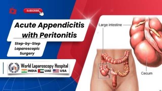 Ideal Laparoscope in Laparoscopic Surgery