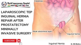 Abdominal Entry Technique in Laparoscopic Surgery