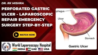 Emergency Laparoscopic Repair of a Perforated Gastric Ulcer