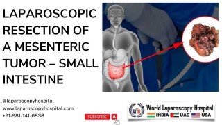 Laparoscopic Excision of a Rare Mesenteric Tumor