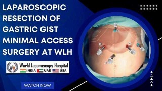Keyhole Surgery for Gastric GIST: Precision Laparoscopic Resection