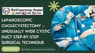 Managing a Wide Cystic Duct: Laparoscopic Cholecystectomy Technique