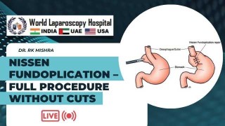 Complete Laparoscopic Nissen Fundoplication – No Cut Video Guide