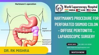 Emergency Laparoscopic Hartmann’s for Perforated Sigmoid Colon