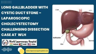 Tough Gallbladder Case: Managing a Long Cystic Duct with Stone