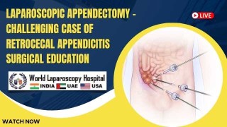 Retrocecal Appendicitis: A Challenging Laparoscopic Appendectomy