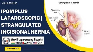 Two port Laparoscopic Appendicectomy with Stryker Mini Alligator