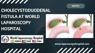 Laparoscopic Resolution of Cholecystoduodenal Fistula: A Modern Approach