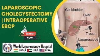 Integrated Laparoscopic Cholecystectomy with Intraoperative ERCP Guidance